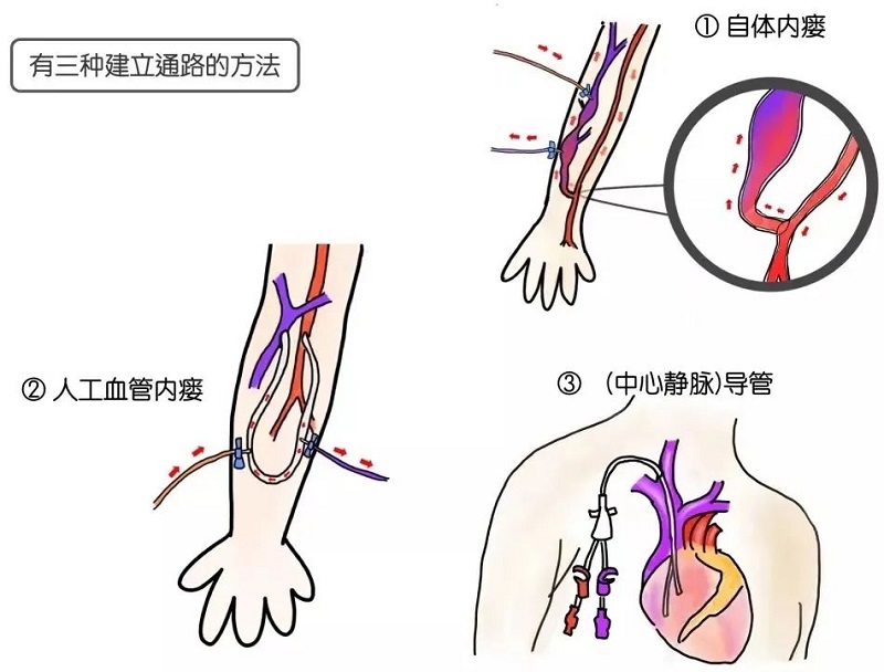 血管通路多學(xué)科診療模式，守護(hù)血透患者“生命線”