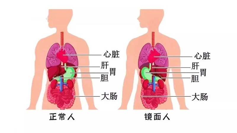 百萬分之一罕見“鏡面人”！五臟六腑反著長，手術也得反著來！