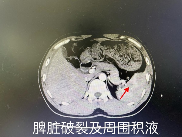 萬載縣首例——我院肝膽外科成功自主實施一例高難度全腹腔鏡下全脾切除術(shù)