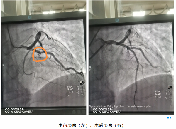 與死神賽跑，為生命接力——我院成功 搶救一名急性心肌梗死患者